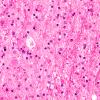 4B1 Neuroaxonal Leukodystrophy (Case 4) H&E 2