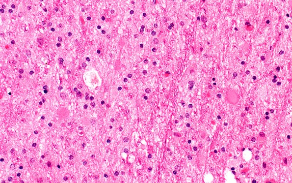 4B1 Neuroaxonal Leukodystrophy (Case 4) H&E 2