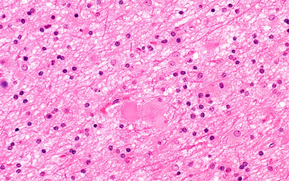 4B2 Neuroaxonal Leukodystrophy (Case 4) H&E 3