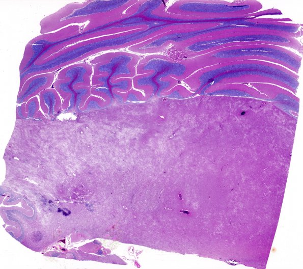 5A Neuroaxonal Leukodystrophy (Case 5, Npath Exchange) H&E whole mount