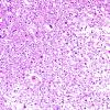 5B1 Neuroaxonal Leukodystrophy (Case 5, Npath Exchange) H&E 1