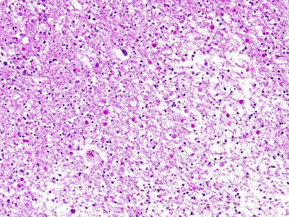 5B1 Neuroaxonal Leukodystrophy (Case 5, Npath Exchange) H&E 1