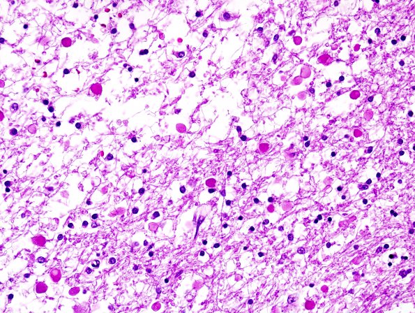 5B2 Neuroaxonal Leukodystrophy (Case 5, Npath Exchange) H&E 2