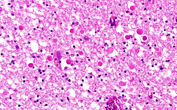 5B3 Neuroaxonal Leukodystrophy (Case 5, Npath Exchange) H&E 3