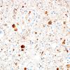 5C1 Neuroaxonal Leukodystrophy (Case 5, Npath Exchange) NF 7