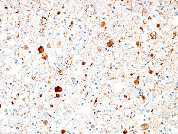 5C1 Neuroaxonal Leukodystrophy (Case 5, Npath Exchange) NF 7