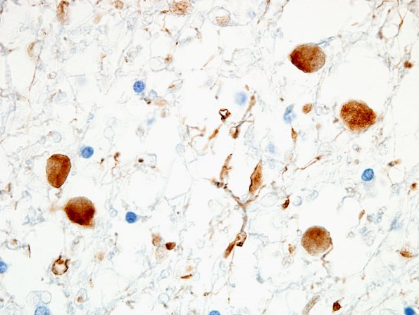 5C2 Neuroaxonal Leukodystrophy (Case 5, Npath Exchange) NF 3