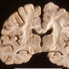 6A Neuroaxonal Leukodystrophy (Case 6)