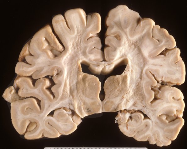 6A Neuroaxonal Leukodystrophy (Case 6)