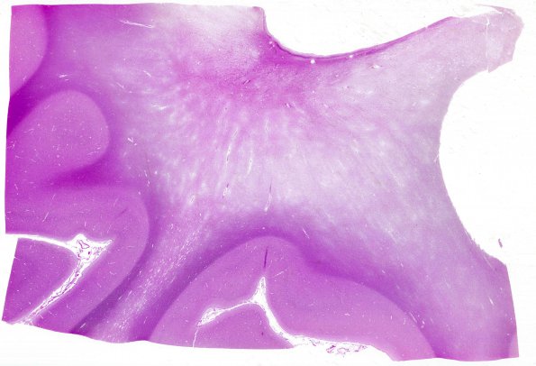 6B1 Neuroaxonal Leukodystrophy (DHMC Case 6) H&E WM