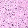 6B2 Neuroaxonal Leukodystrophy (DHMC Case 6) H&E 2