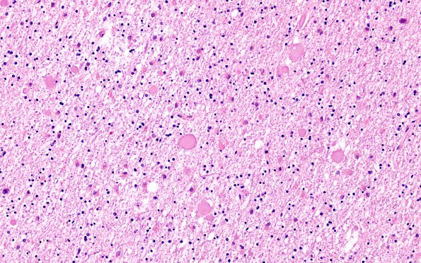 6B2 Neuroaxonal Leukodystrophy (DHMC Case 6) H&E 2