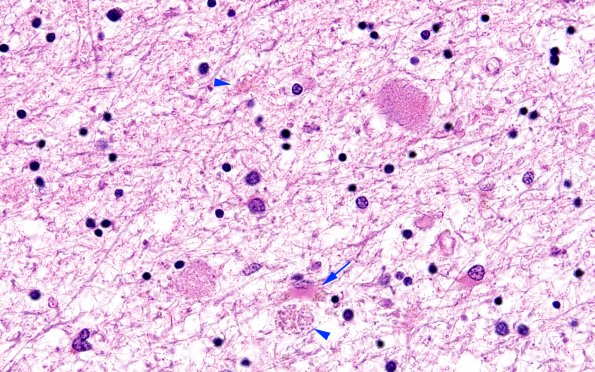 6B3 Neuroaxonal Leukodystrophy (DHMC Case 6) H&E 1A copy