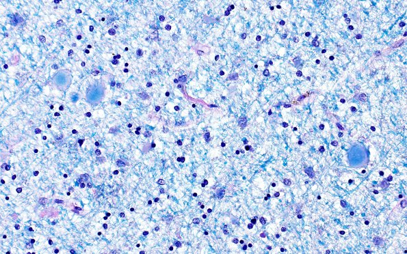 6C2 Neuroaxonal Leukodystrophy (DHMC Case 6) LFB-PAS 2