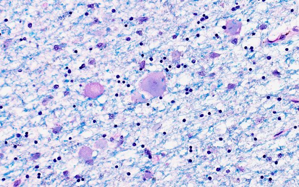 6C3 Neuroaxonal Leukodystrophy (DHMC Case 6) LFB-PAS 1