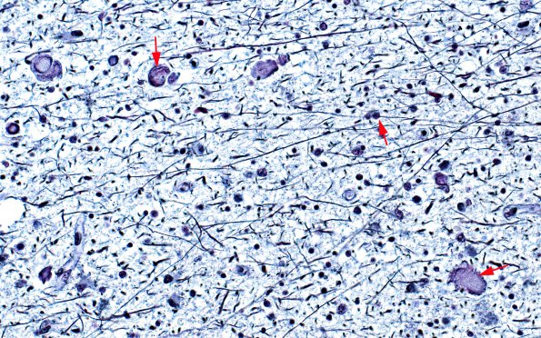 6D3 Neuroaxonal Leukodystrophy (DHMC Case 6) Bodian 1 copy