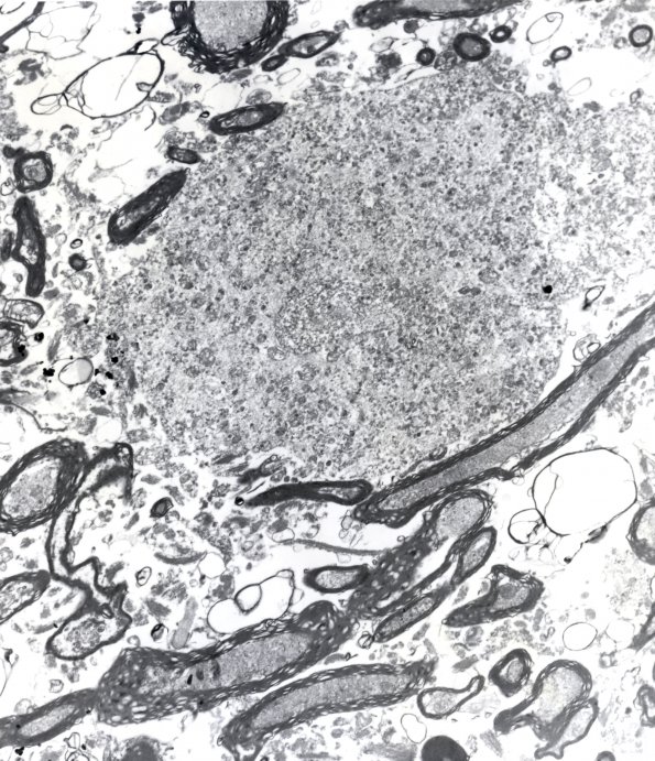 6E1 Neuroaxonal Leukodystrophy (DHMC Case 6) Bill Hickey EM 1A - Copy