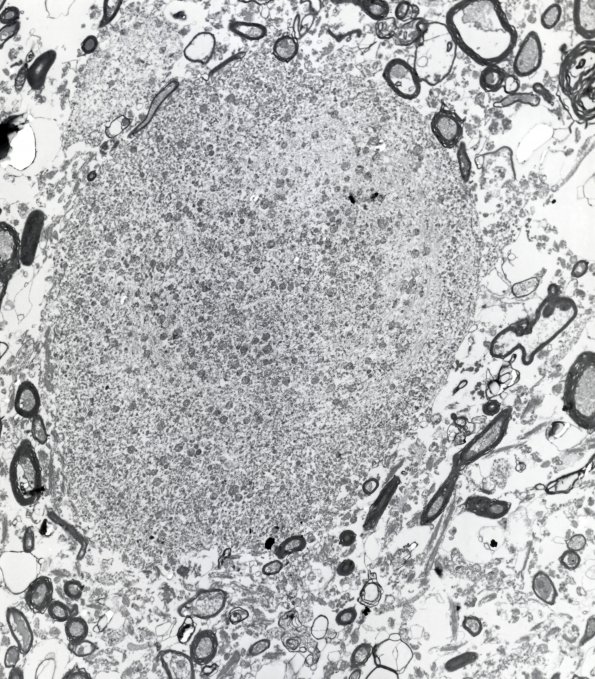 6E2 Neuroaxonal Leukodystrophy (DHMC Case 6) Bill Hickey EM 3 - Copy