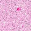 7A3 Neuroaxonal Leukodystrophy (AANP 1999, Case 9) X20 3