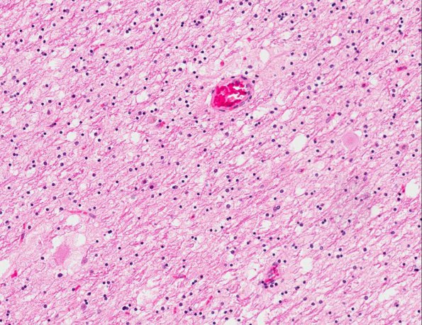 7A3 Neuroaxonal Leukodystrophy (AANP 1999, Case 9) X20 3