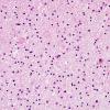 8B1 Neuroaxonal Leukodystrophy (HDLS-POLD, CANP 2009 Case 7) H&E 20