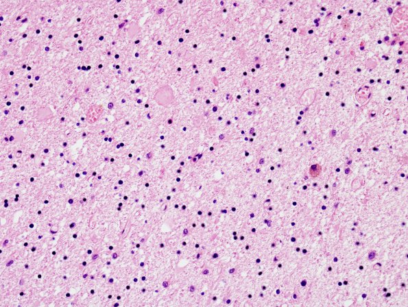 8B1 Neuroaxonal Leukodystrophy (HDLS-POLD, CANP 2009 Case 7) H&E 20