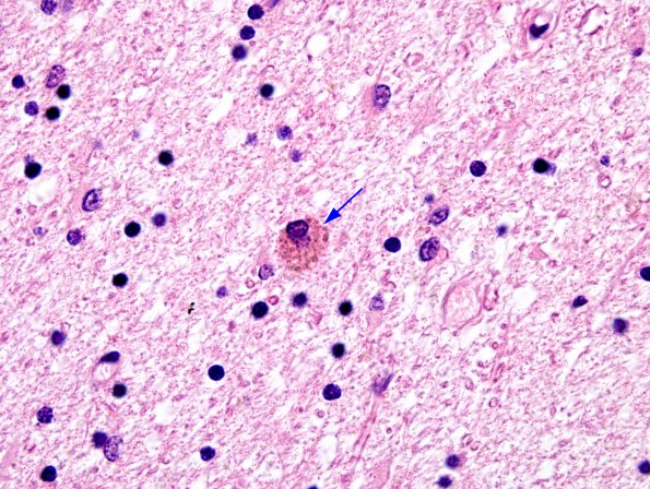 8B2 Neuroaxonal Leukodystrophy (HDLS-POLD, CANP 2009 Case 7) H&E 3 copy