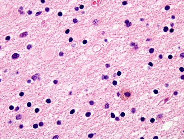 8B3 Neuroaxonal Leukodystrophy (HDLS-POLD, CANP 2009 Case 7) H&E 11