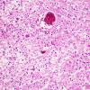 9A Neuroaxonal Leukodystrophy (Case 9) H&E 1