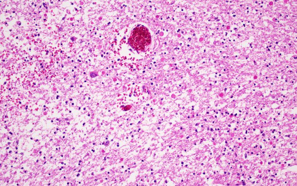 9A Neuroaxonal Leukodystrophy (Case 9) H&E 1