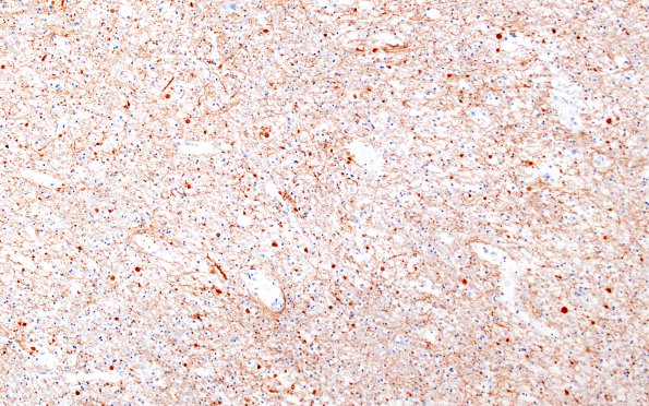 9B1 Neuroaxonal Leukodystrophy (Case 9) NF 10X