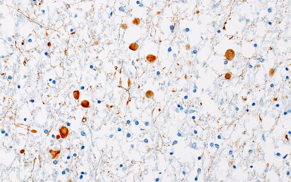 9B2 Neuroaxonal Leukodystrophy (Case 9) NF 40X