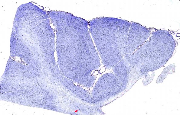 2C1 Pelizaeus-Merzbacher Dz, infantile (AANP 1986, Case 3) LFB-PAS X0