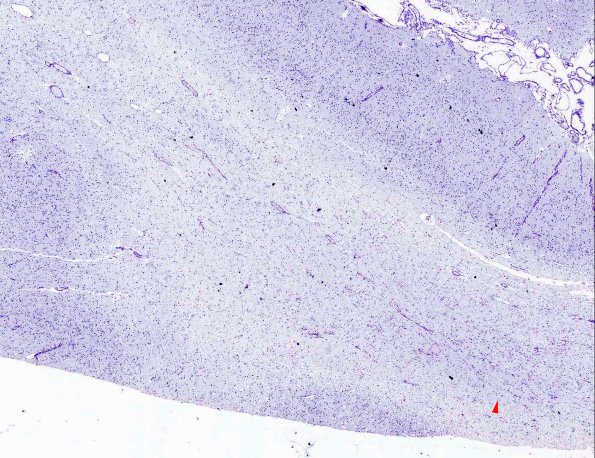 2C2 Pelizaeus-Merzbacher Dz, infantile (AANP 1986, Case 3) LFB-PAS X2 1 copy