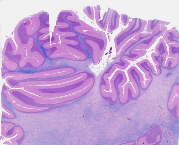 1A1 Solvent Vaport Leukoencephalopathy (AANP 1995, Case 2) LFB-PAS WM