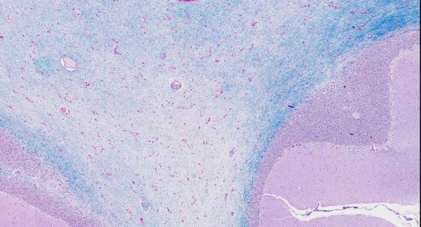 1A2 Solvent-Vapor Leukoencephalopathy (AANP 1995-2) JNEN 53-389 LFB-PAS 2.6X