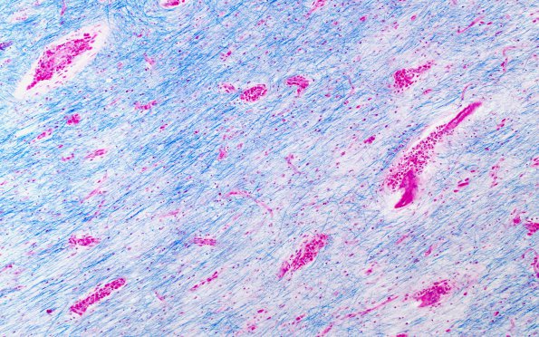 1A3 Solvent Vaport Leukoencephalopathy (AANP 1995, Case 2) LFB-PAS 2