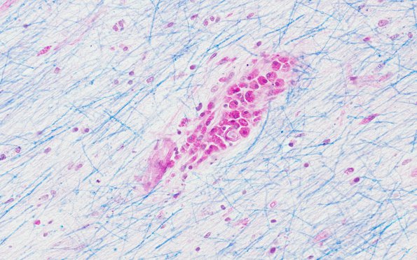 1A4 Solvent Vaport Leukoencephalopathy (AANP 1995, Case 2) LFB-PAS 3