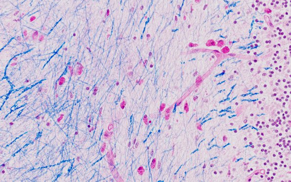 1A6 Solvent Vapor Leukoencephalopathy (AANP 1995, Case 2) LFB-PAS 5