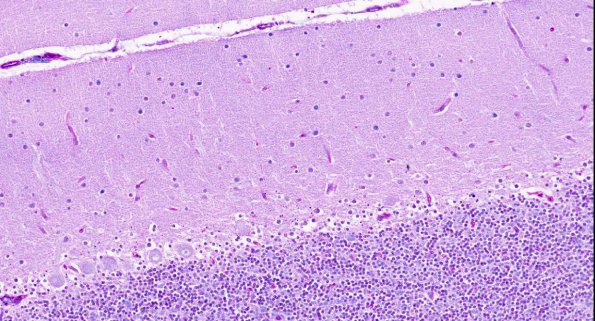 1A7 Solvent-Vapor Leukoencephalopathy (AANP 1995-2) JNEN 53-389 LFB-PAS 13.8X 1