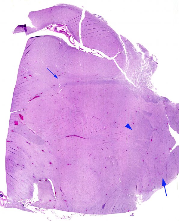 1B1  VWM Dz (AANP 2008 Case 1, Thx Carrie Mohila) H&E WM copy