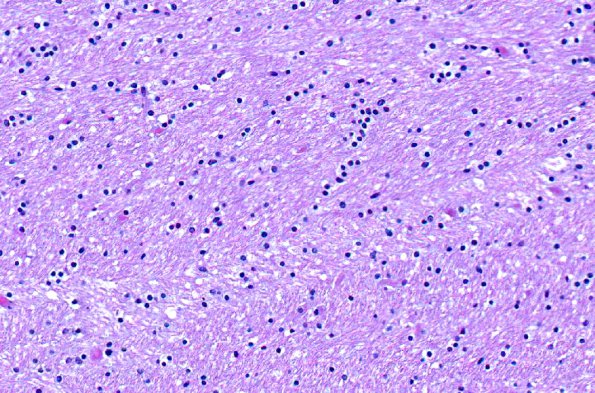 1B2 Vanishing White Matter Disease (AANP 2008 Case 1) 13.8X 3 nl area WM