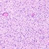 1B3 Vanishing White Matter Disease (AANP 2008 Case 1) H&E Mohila slide 10X 2