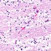 1B6 Vanishing White Matter Disease (AANP 2008 Case 1) H&E 2 copy