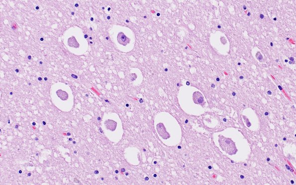 1C Vanishing White Matter Disease (AANP 2008 Case 1) H&E 6