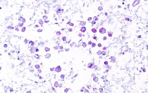 2B4 Vanishing White Matter DZ Alcian-blue PAS (Kondi Wong Case) 40X 1