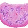 10A3 Craniopharyngioma (Case 10) H&E 14