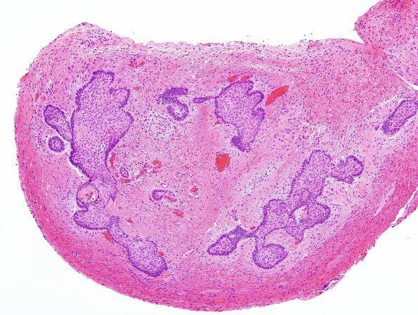 10A3 Craniopharyngioma (Case 10) H&E 14