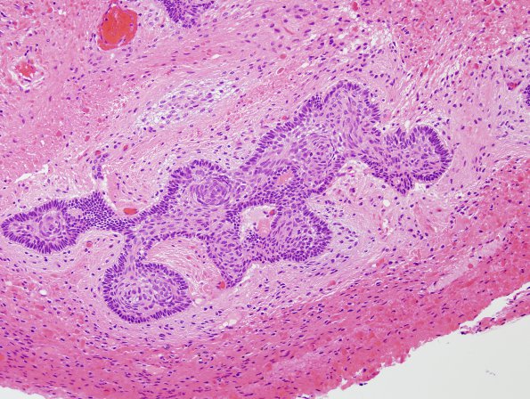 10A4 Craniopharyngioma (Case 10) H&E 13