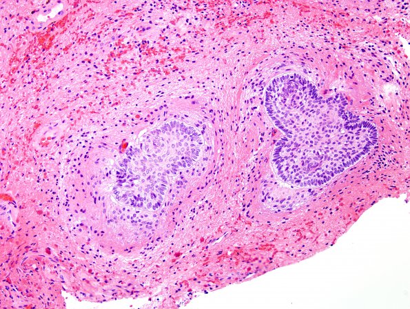 10A6 Craniopharyngioma (Case 10) H&E 17